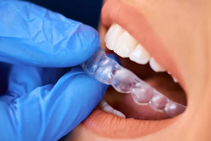 Clear orthodontic aligners