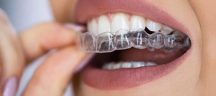 Clear orthodontic aligners