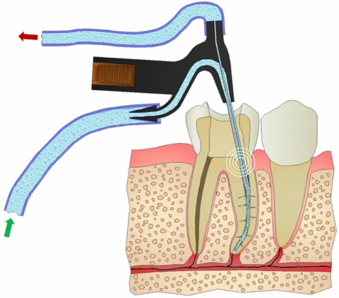 Root Canal Research